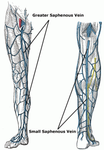 Endovenous Laser Therapy (evlt) Vernon 