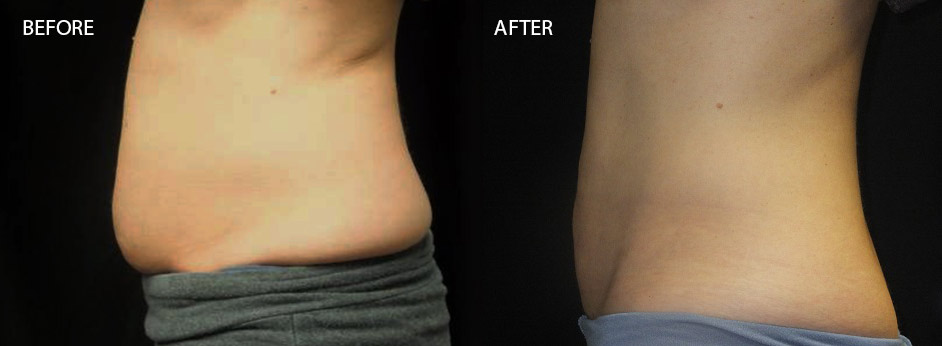 coolsculpting-before-and-after-03