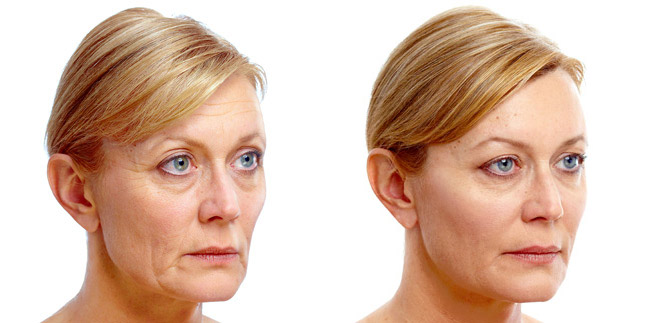 before-after-juvederm